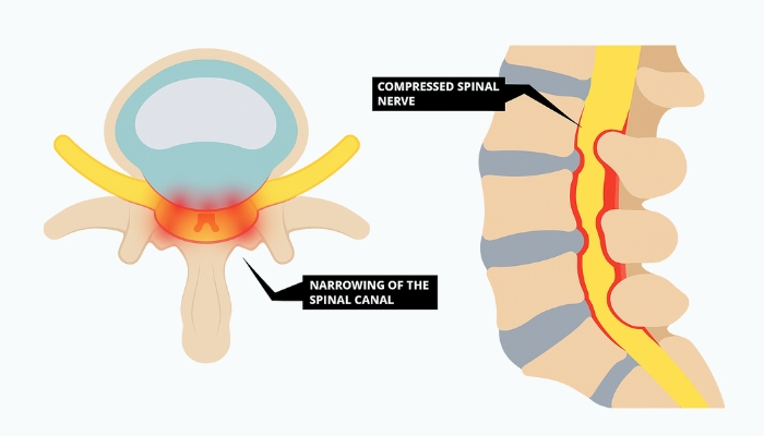 Canal Stenosis