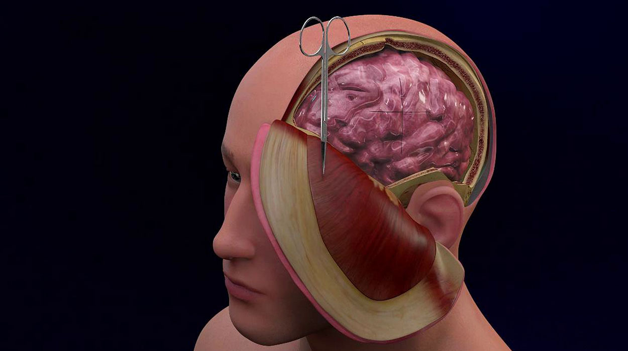 Decompressive Craniectomy disease Treatment in Greater Noida