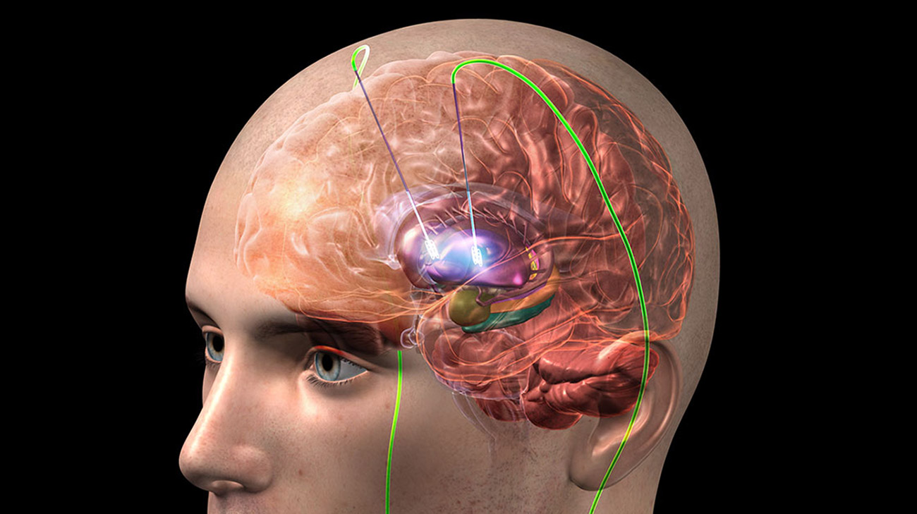 Deep Brain Stimulation Treatment in Greater Noida