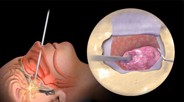 Endoscopic Navigation Based Tumor Excision in Greater Noida