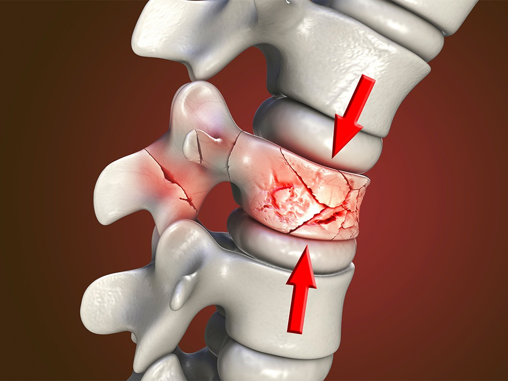 Kyphoplasty