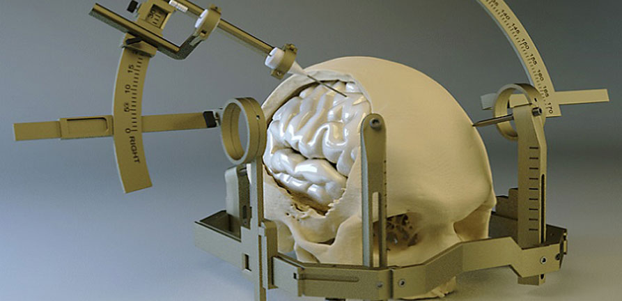 Stereotactic Tumor Biopsy in Greater Noida