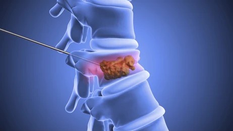 Vertebroplasty