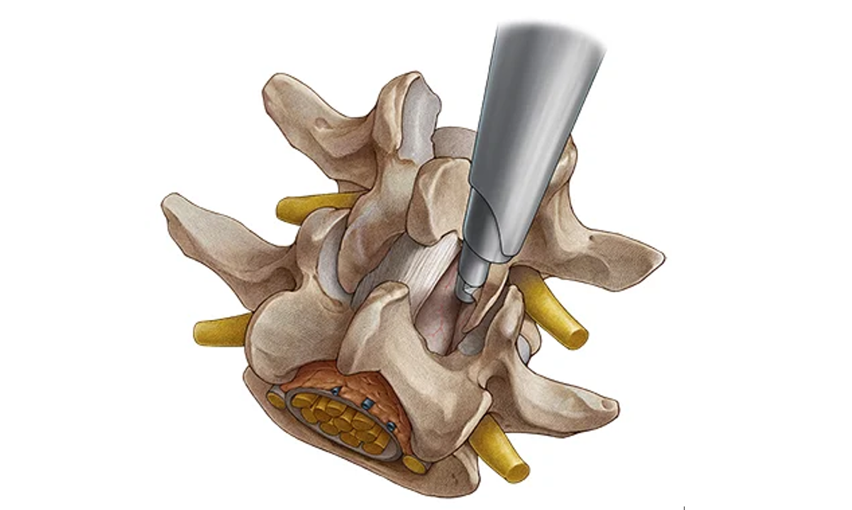 Central Canal Stenosis Treatment in Greater Noida