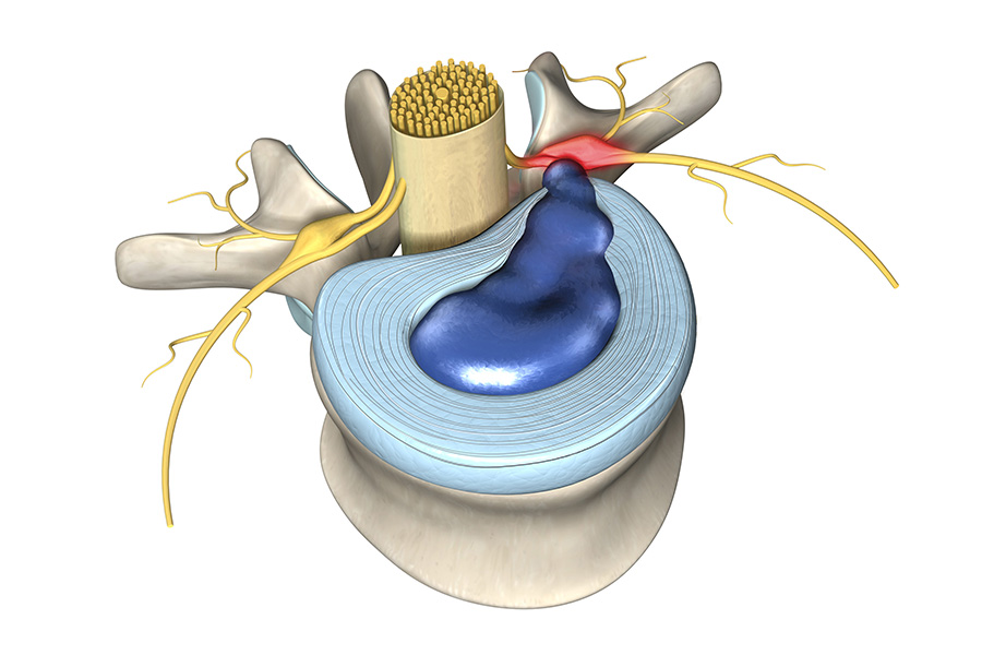 Cervical Spine Disc Herniation Treatment in Greater Noida