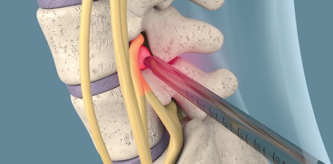 Disc Herniation Treatment in Greater Noida