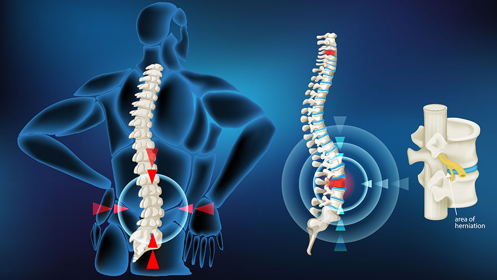 Disc Herniation Treatment in Greater Noida