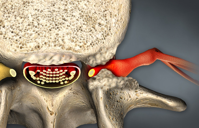 Foraminal Stenosis Treatment in Greater Noida