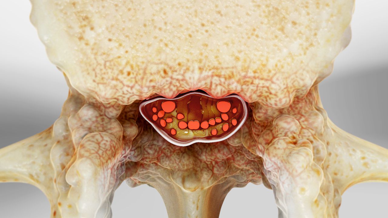 Lateral Recess Stenosis Treatment in Greater Noida